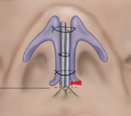 Q. While applying ointment inside my nose, I felt as if the implant had moved. Could this change the shape of my nose? image 1