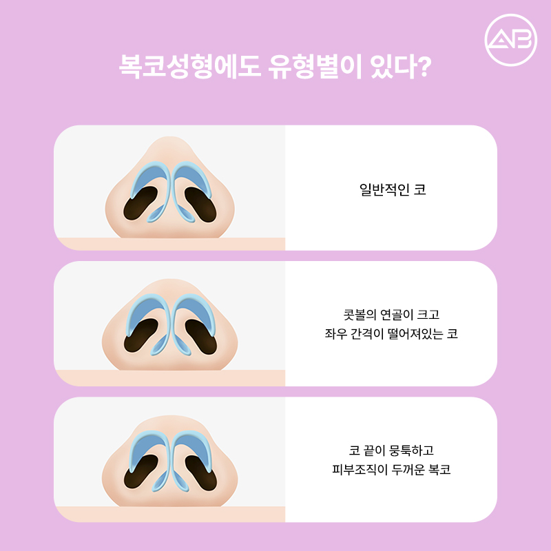 Why AB Plastic Surgery Is Famous for Bulbous Nose Surgery image 2