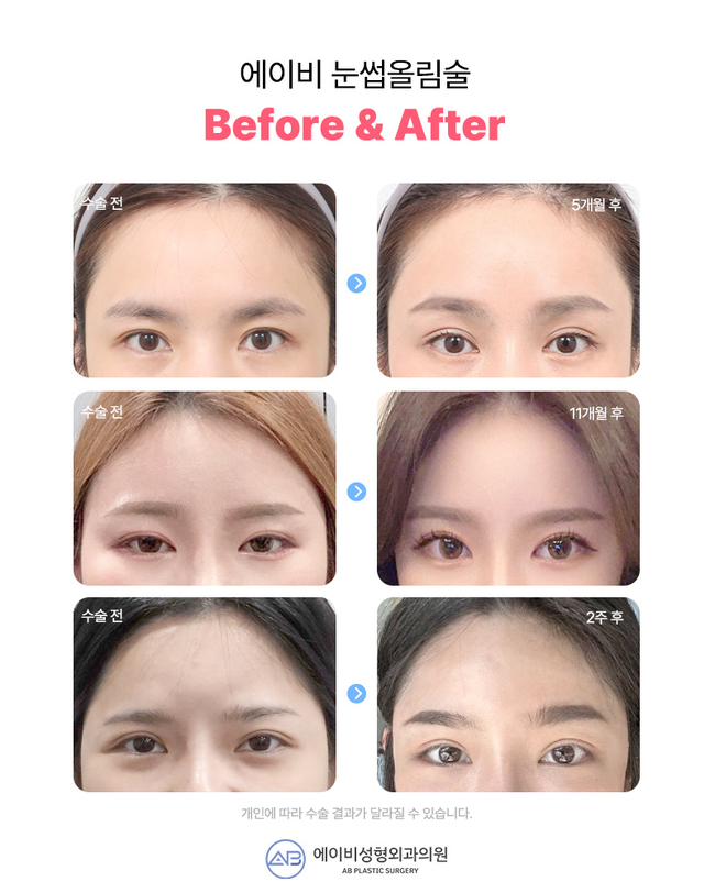 If You’re Still Thinking About a Brow Lift image 7