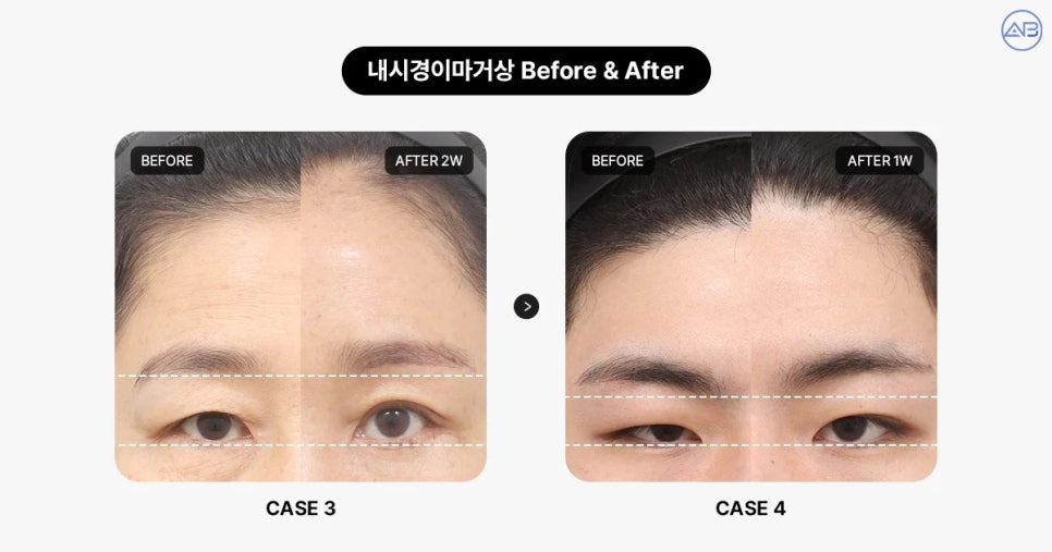 AB Plastic Surgery Endoscopic Forehead Lift: Key to Improving Eye Appearance Before and After Changes! image 5