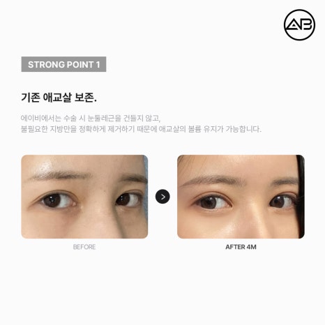 AB Plastic Surgery Under-Eye Fat Repositioning: Effects on Dark Circles and Hollow Under-Eyes, Before-and-After Results, and Side Effects image 4