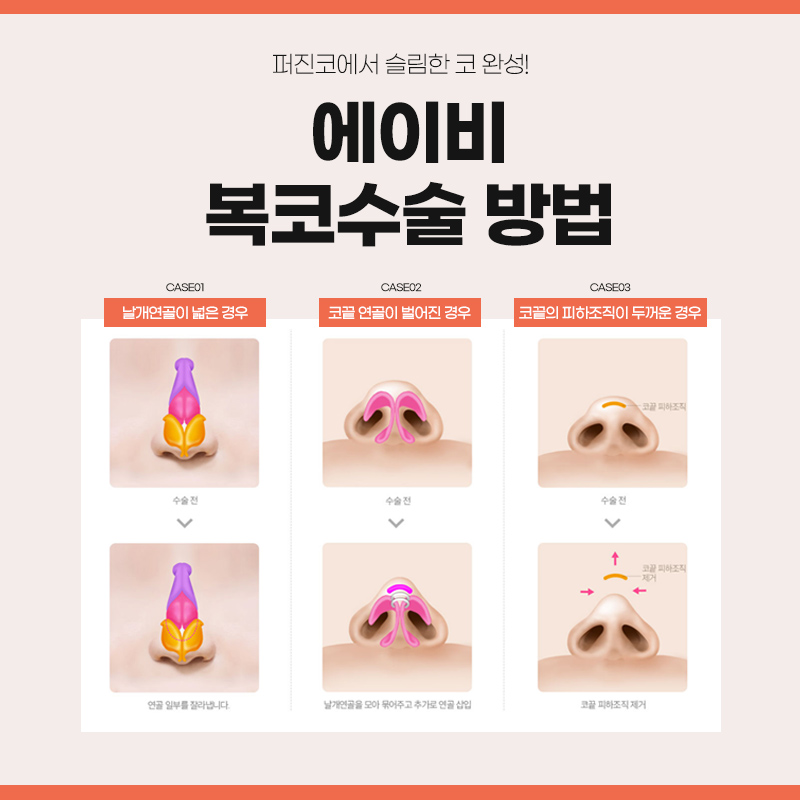 복코성형 이것만은 알고하자 관련 이미지 3