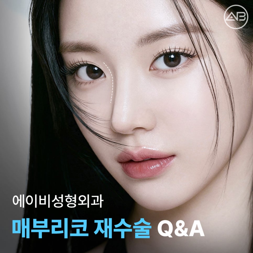 에이비성형외과 매부리코재수술 코절골술이 필요한 경우와 교정 원리 관련 이미지 1