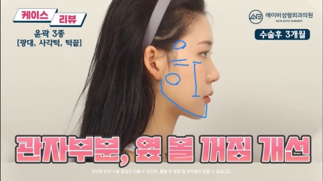 #에이비성형외과#에이비tv#케이스리뷰#안면윤곽성형 관련 이미지 7