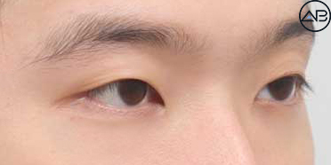 AB Plastic Surgery Men’s Eye Surgery - First Snow Case Review image 2