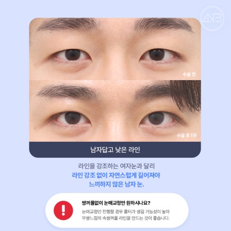 인상을 바꾸는 첫 시작, 에이비성형외과 남자눈성형 관련 이미지 9