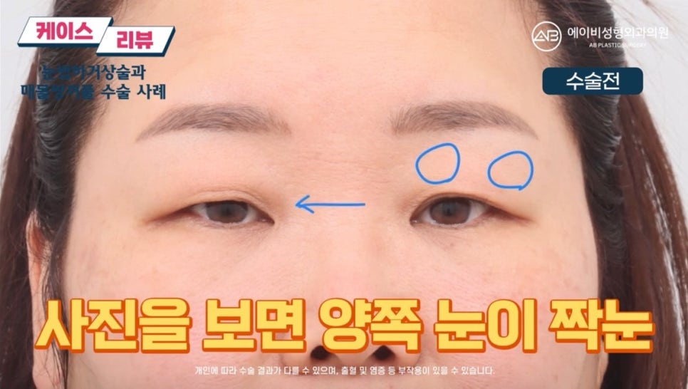 #에이비성형외과#에이비tv#케이스리뷰#중년눈성형 관련 이미지 1
