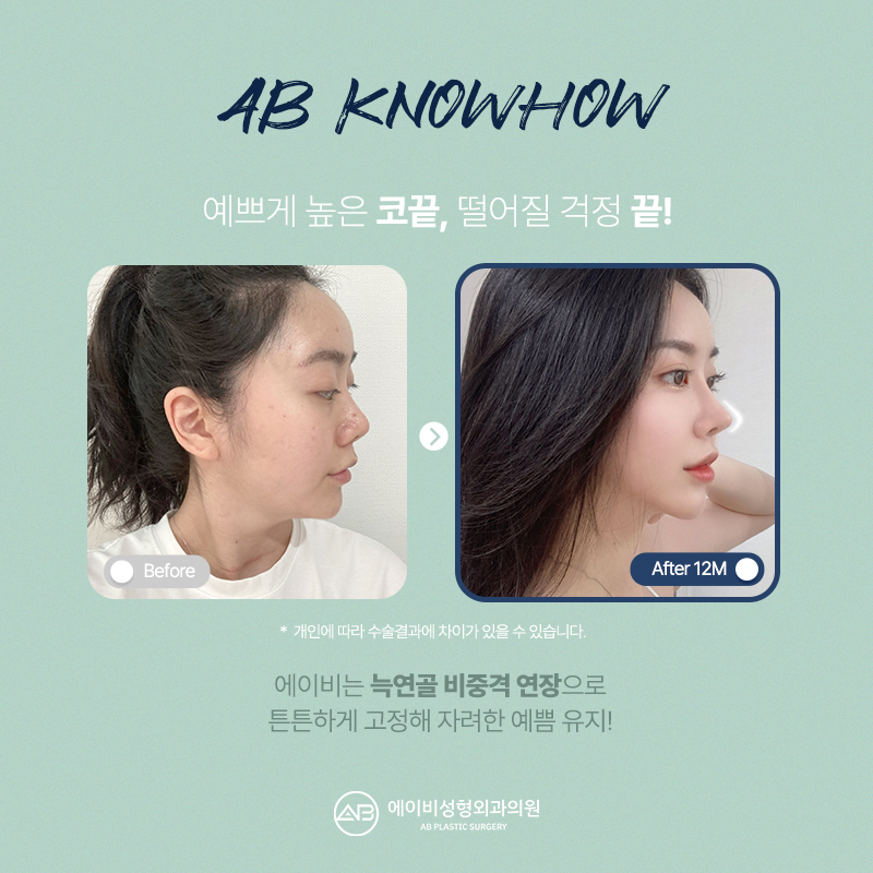 Key Points of AB Plastic Surgery’s Refined Nose Surgery image 7