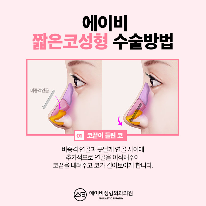 If You’re Looking Into Short Nose Surgery, Pay Attention to This Place image 3