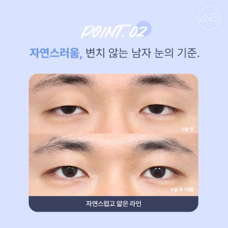 인상을 바꾸는 첫 시작, 에이비성형외과 남자눈성형 관련 이미지 8
