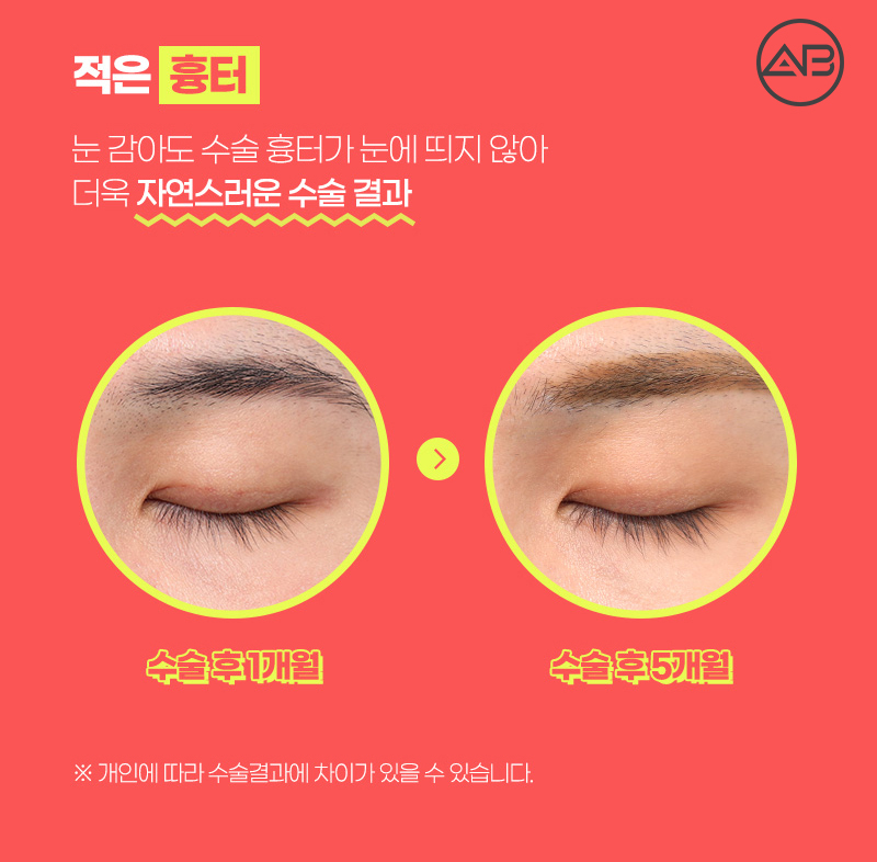 남자쌍수후기 시원하고 자연스럽게 에이비성형외과 관련 이미지 4