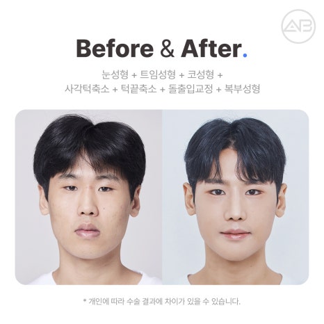 AB Plastic Surgery MAKE미남 Episode 4 - Looking Into Bangguseoknaeman’s Nose Surgery! image 11