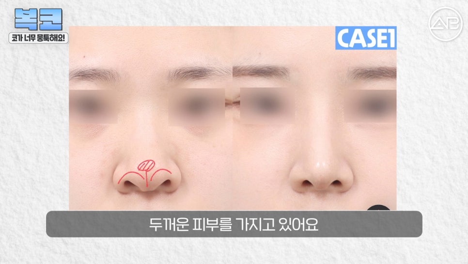 #에이비성형외과#에이비tv#코성형#복코성형 관련 이미지 13