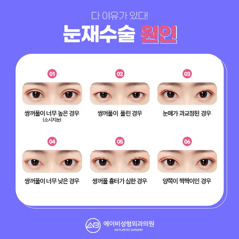 What Is AB Plastic Surgery Like for Double Eyelid Revision Surgery Reviews? image 2