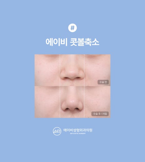 에이비성형외과 콧볼축소 수술전후 관련 이미지 7
