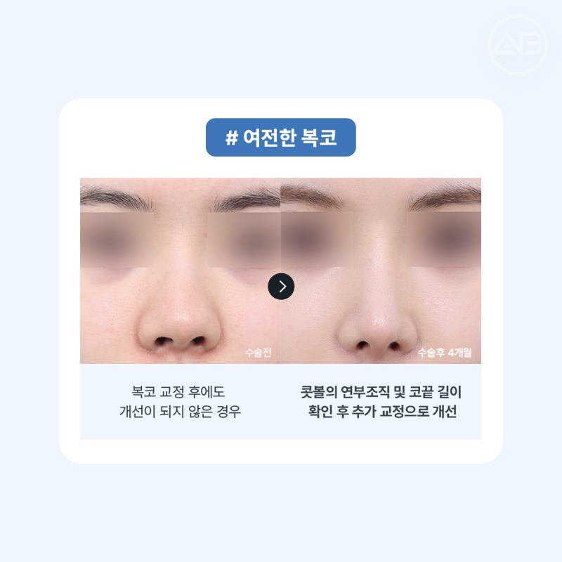 코재수술 필요하다면 에이비성형외과 관련 이미지 4