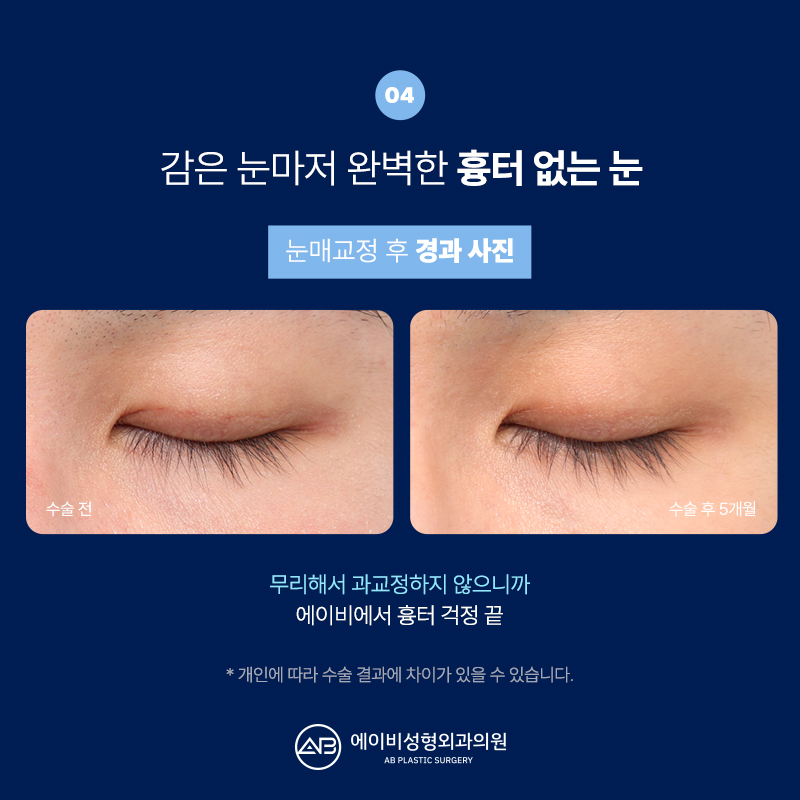 남자눈매교정 잘하는 에이비성형외과 다른점은 뭘까? 관련 이미지 9