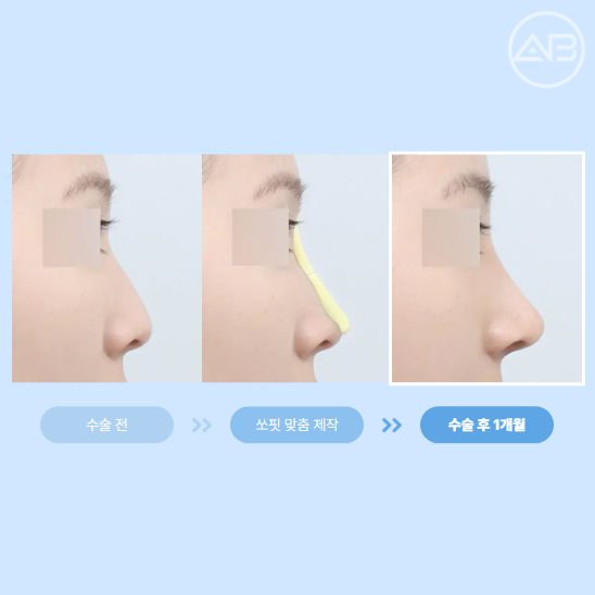 에이비성형외과 쏘핏 맞춤보형물 코성형 궁금증 해결하기 관련 이미지 4