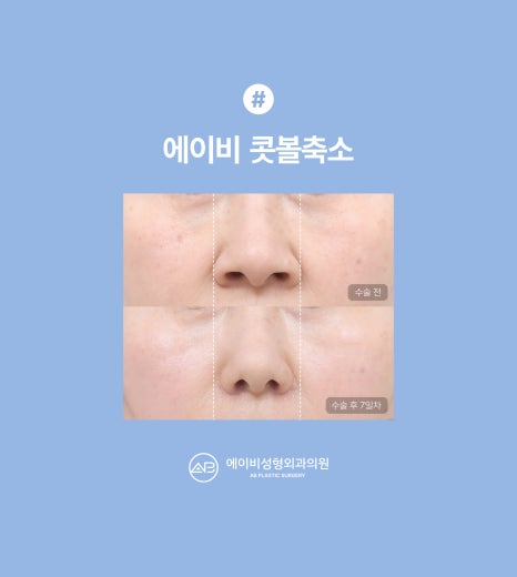 에이비성형외과 콧볼축소 수술전후 관련 이미지 4