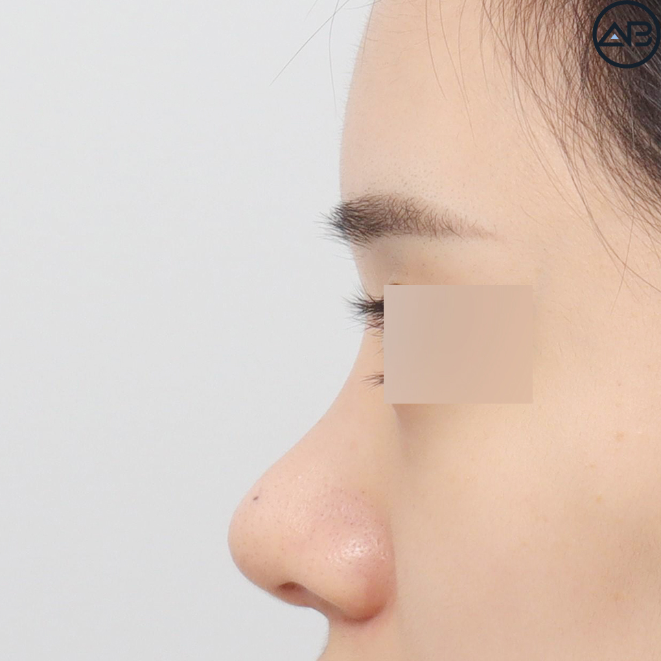 AB Plastic Surgery Refined Rhinoplasty - Revision Surgery Case Review image 5
