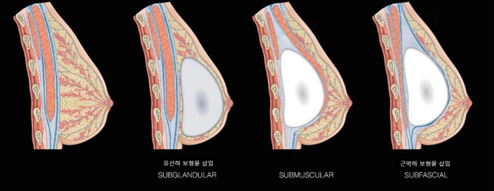[유방확대] 근막하 가슴수술과 유선하 가슴수술 어떤 차이가 있나요 관련 이미지 3