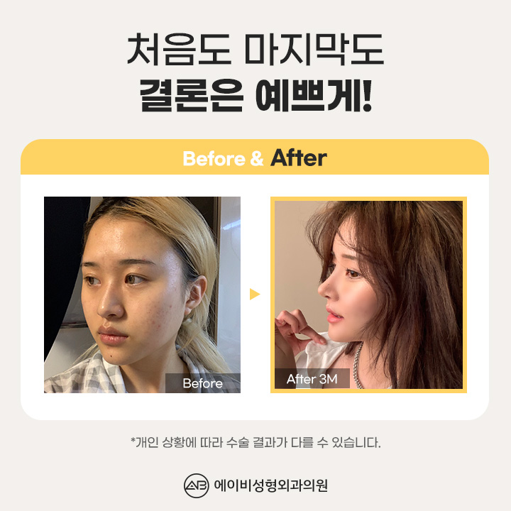 자가연골코성형 나라면 여기서 관련 이미지 4