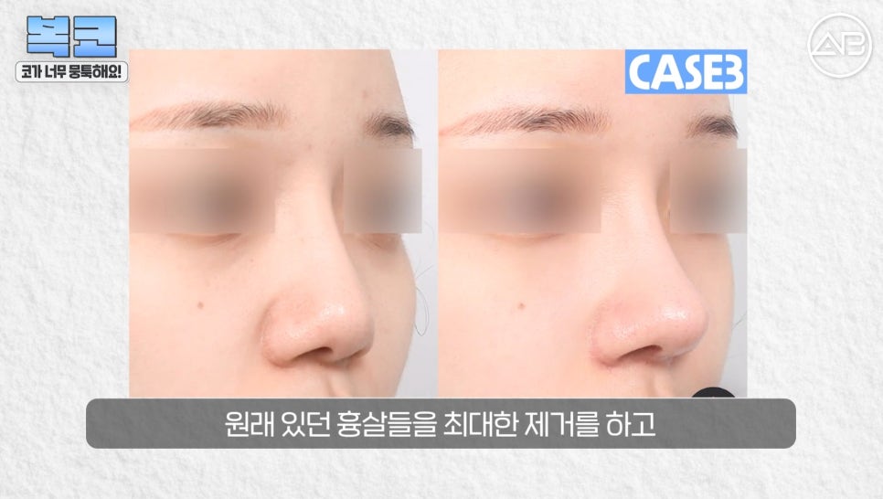 #에이비성형외과#에이비tv#코성형#복코성형 관련 이미지 21