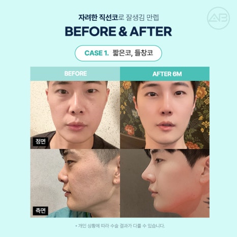 남자직선코성형 왜 에이비성형외과일까? 관련 이미지 10