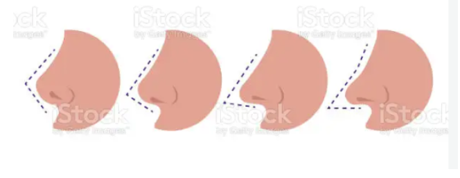 [칼럼] 코수술 후 코끝이 너무 들려 보이는데 언제쯤 내려가나요? 관련 이미지 4