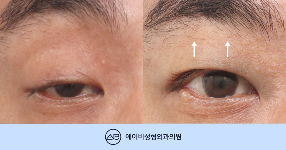 [눈매교정 하면 안되는 이유, 중증 안검하수의 진실] 관련 이미지 1