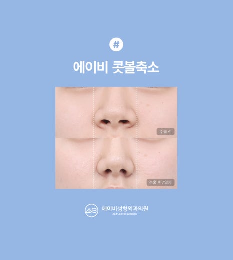 에이비성형외과 콧볼축소 수술전후 관련 이미지 2