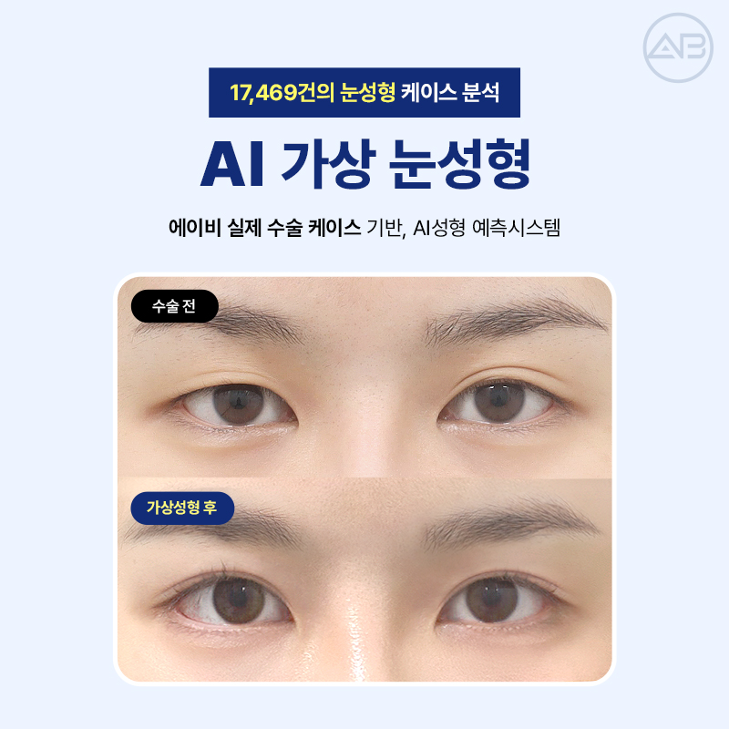에이비성형외과 AI 가상 눈성형 원하는 결과를 미리 볼 수 있다! 관련 이미지 7