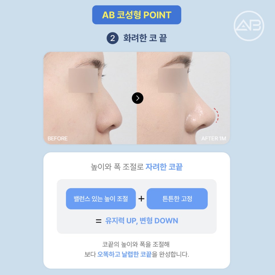 에이비성형외과 코끝처짐교정 원인부터 비주교정수술 비순각교정 핵심 정리 관련 이미지 3