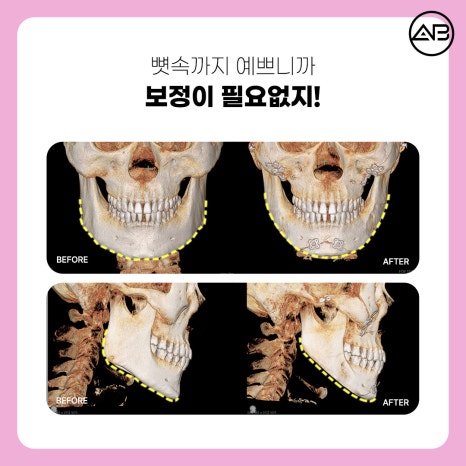 자려한안면윤곽 원한다면 AB성형외과 관련 이미지 7