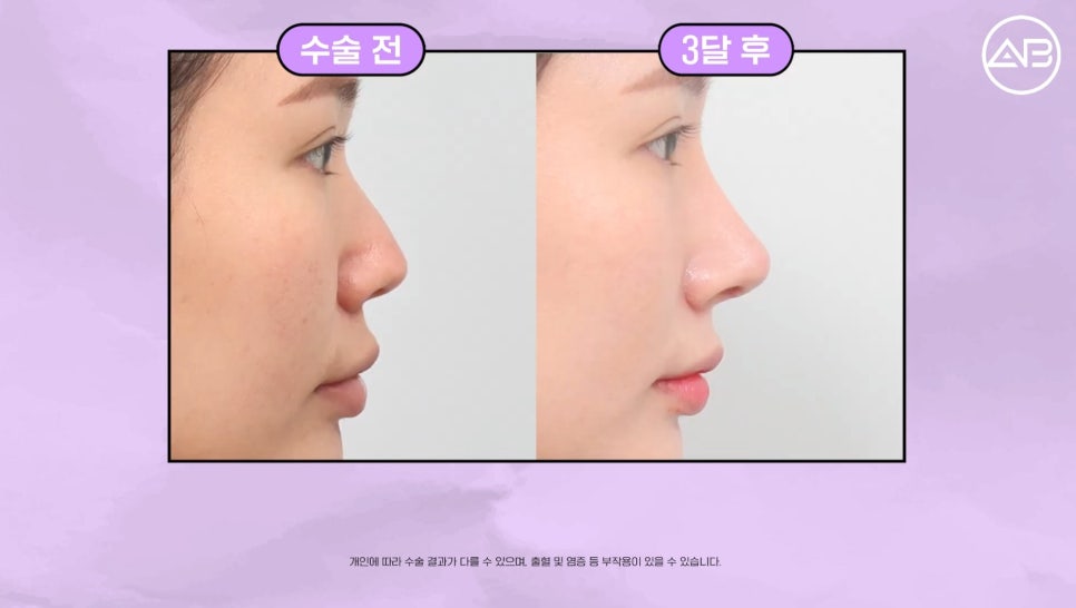 #에이비성형외과#에이비tv#케이스리뷰#코성형 관련 이미지 7