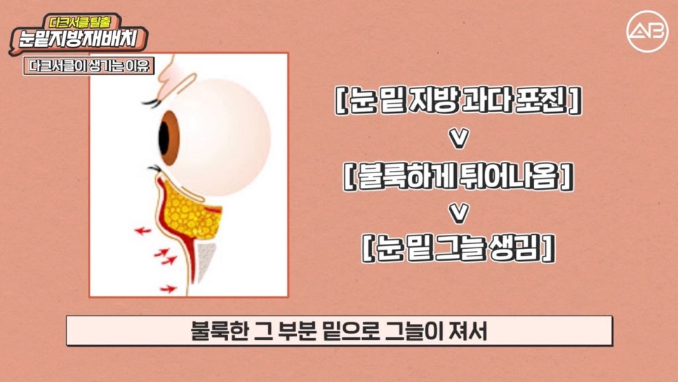 #AB Plastic Surgery #AB TV #Eye Surgery #Under-Eye Fat Repositioning image 2