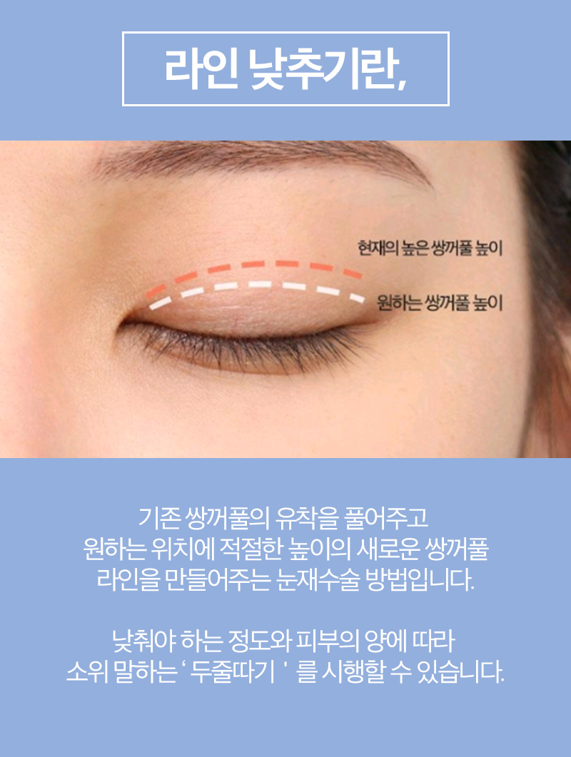 쌍꺼풀재수술잘하는병원 찾고 있다면! AB성형외과! 관련 이미지 3