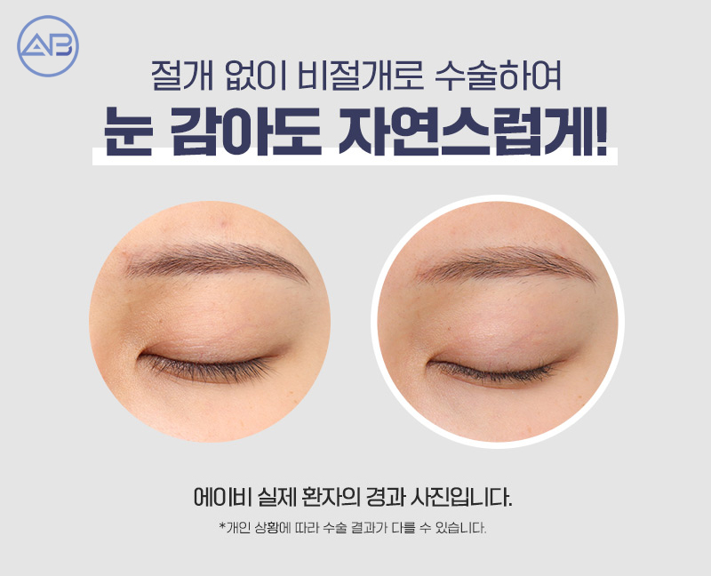 눈매교정수술후기 에이비성형외과에서 확인해 관련 이미지 2