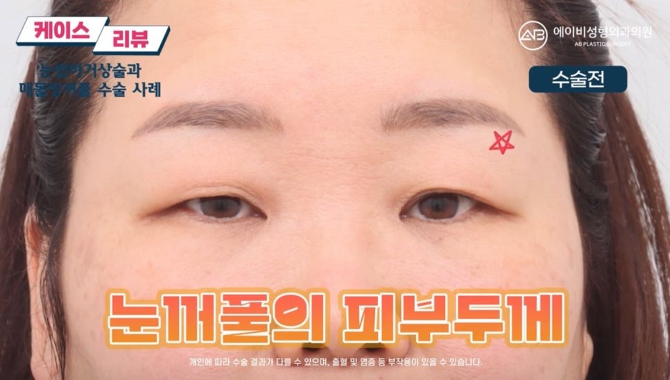 #에이비성형외과#에이비tv#케이스리뷰#중년눈성형 관련 이미지 3