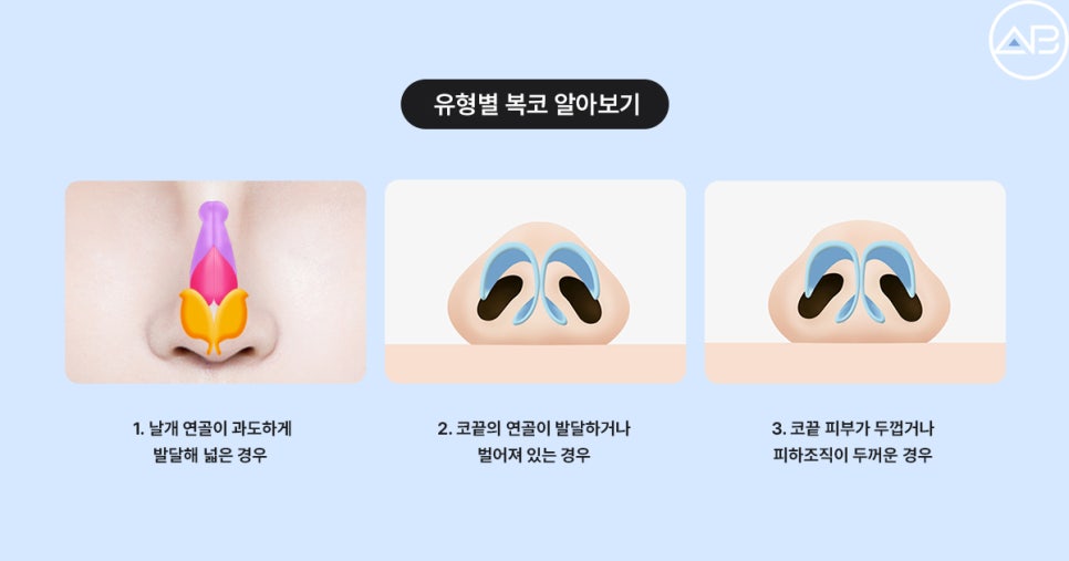 복코성형 전후효과 보려면? (Faet. 에이비성형외과 서찬얼원장) 관련 이미지 3