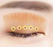 Q. The space between my eyebrows and eyes is narrow, and my eyelids are droopy, so I’ve consulted several places, but everyone recommends something different. What are the differences between ptosis correction, forehead lift, and brow lift under the eyebrow? image 1