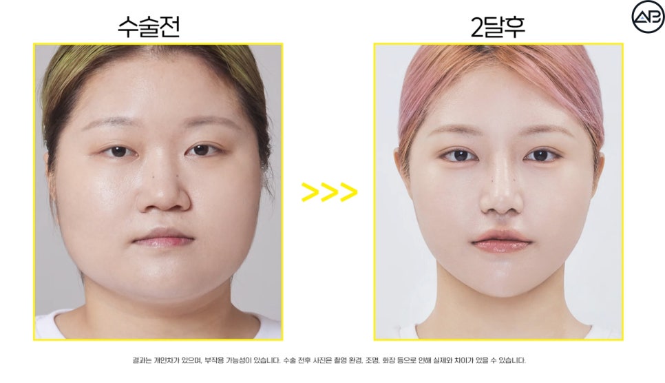 에이비성형외과 관련 이미지 19