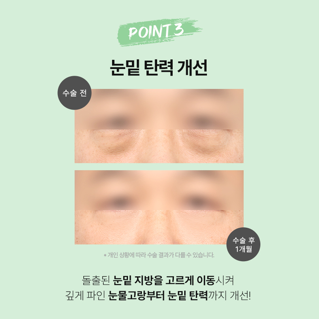 Differences in AB Plastic Surgery’s Mini Lower Blepharoplasty image 5