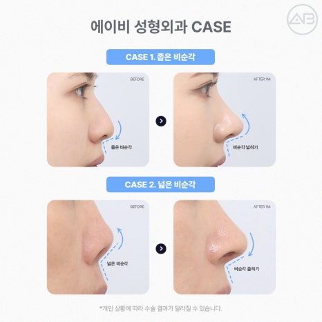 에이비성형외과에서 만나는 자려한 비주라인 코성형 관련 이미지 8