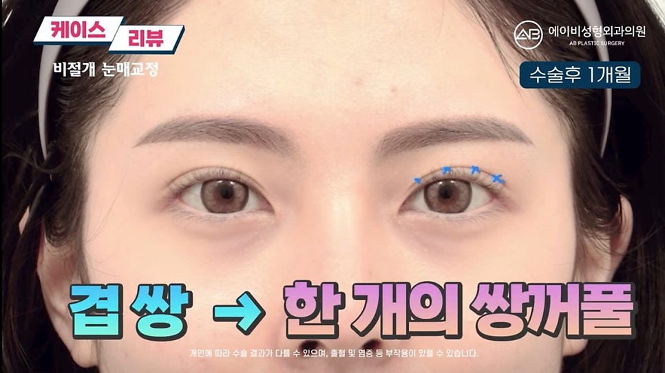 #AB Plastic Surgery #AB TV #Eye Surgery #Non-Incisional Ptosis Correction image 5