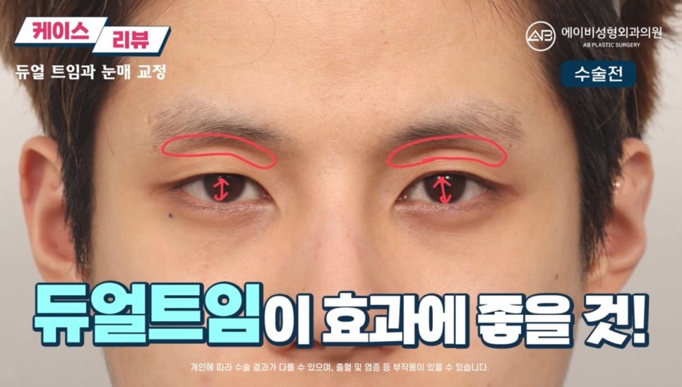 #에이비성형외과#에이비tv#눈성형#남자눈성형 관련 이미지 4