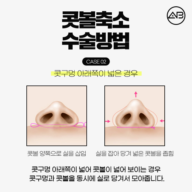 콧볼축소수술 코뚠뚠이의 해결책 관련 이미지 5