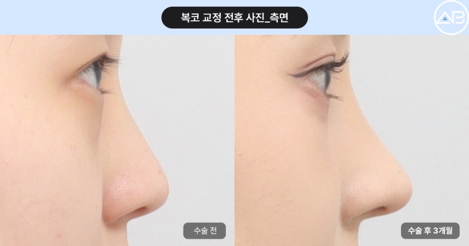 복코성형 전후효과 보려면? (Faet. 에이비성형외과 서찬얼원장) 관련 이미지 8