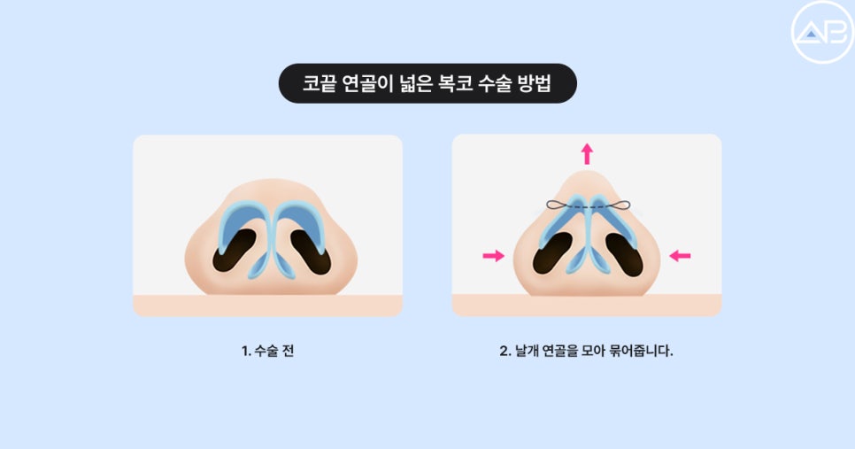 복코성형 전후효과 보려면? (Faet. 에이비성형외과 서찬얼원장) 관련 이미지 5
