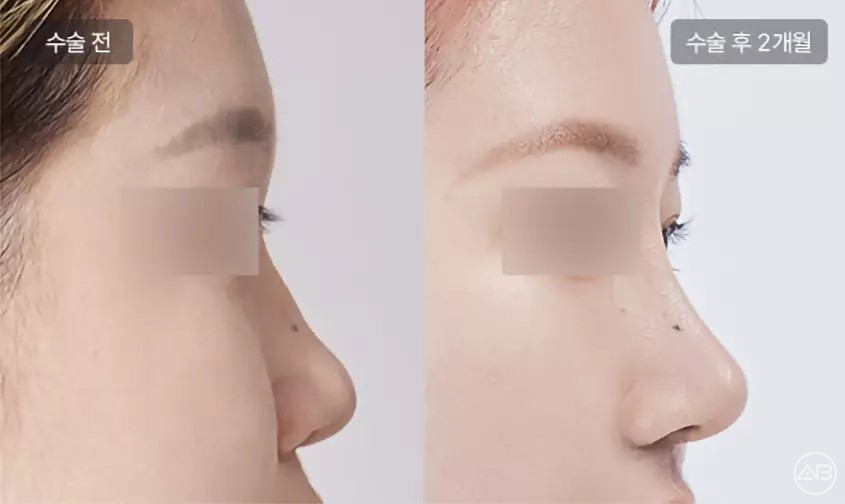 에이비성형외과 자려한 비주라인 코성형수술 관련 이미지 9